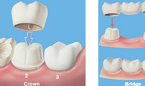 Crowns and Bridges service-8