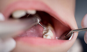 Fillings service-7