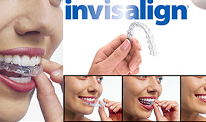 Invisalign service-5