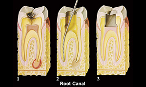 Root Canals service-9