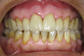teeth-2