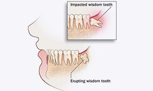 Extractions service-10
