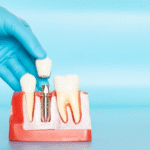 dental implants