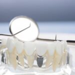 the-benefits-of-dental-implants-why-theyre-the-best-option-for-tooth-replacement
