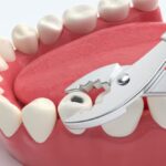 the-pain-free-path-how-modern-tooth-extractions-are-changing-the-game