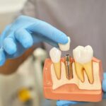 do-dental-implants-prevent-or-reverse-bone-loss