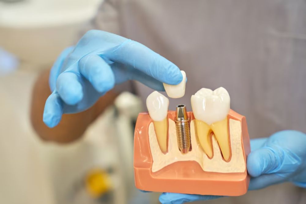 do-dental-implants-prevent-or-reverse-bone-loss