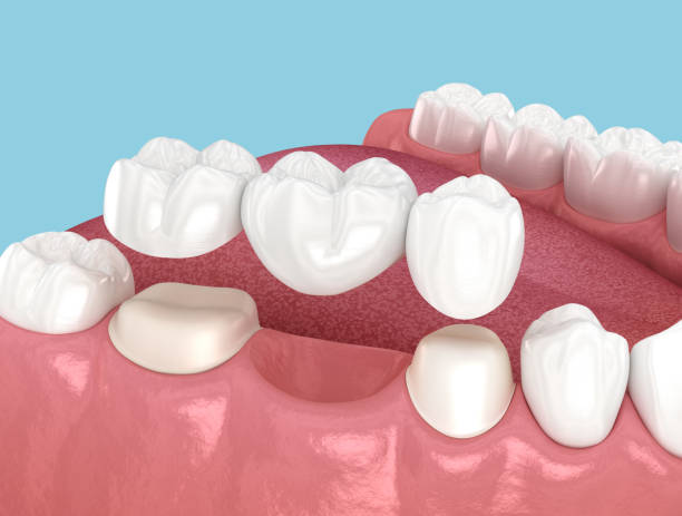 dental bridges near you