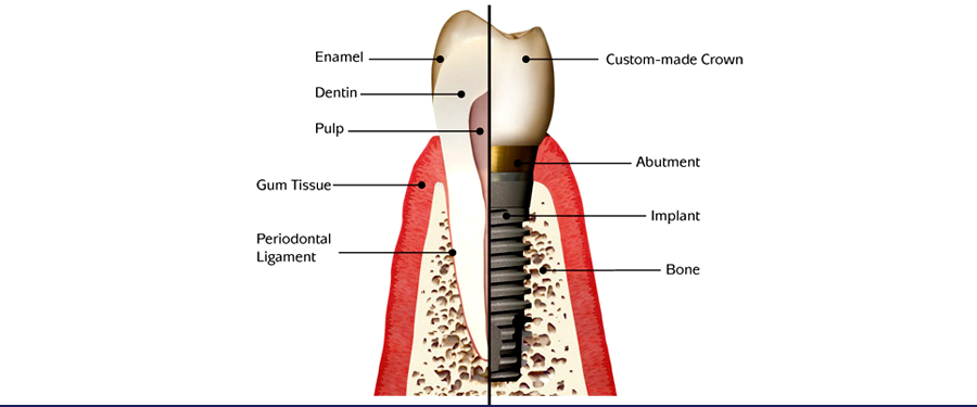 dental implants near you in richmond bc