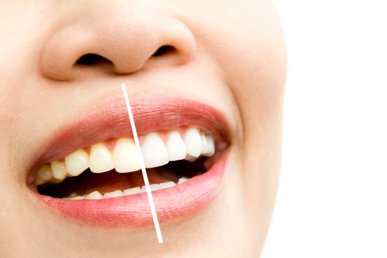 teeth whitening in richmond bc