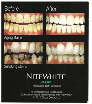 teeth whitening near you