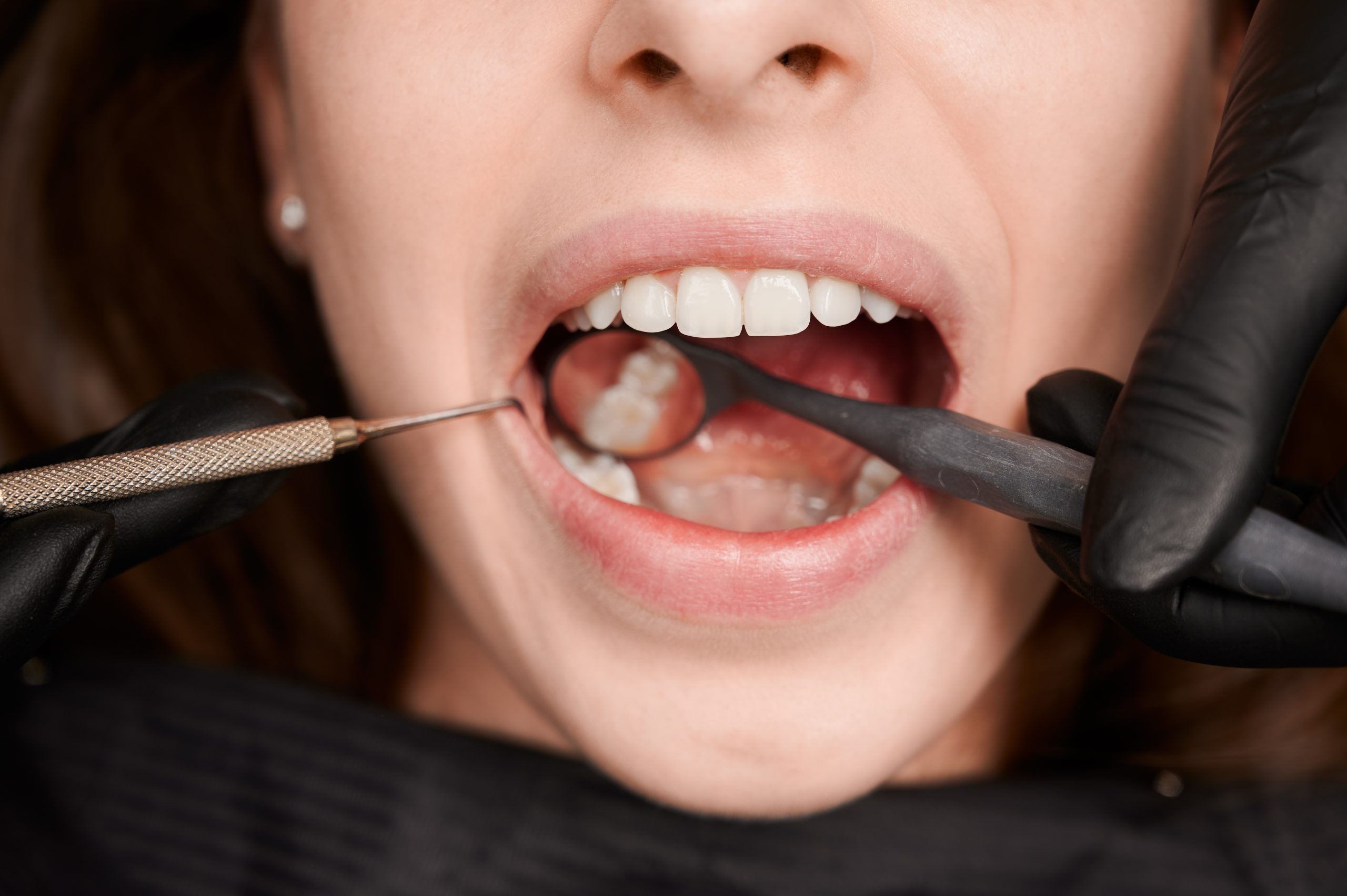 Fix cavities with dental fillings in Richmond. We use tooth-colored materials for strong, natural-looking results. Schedule your visit today!