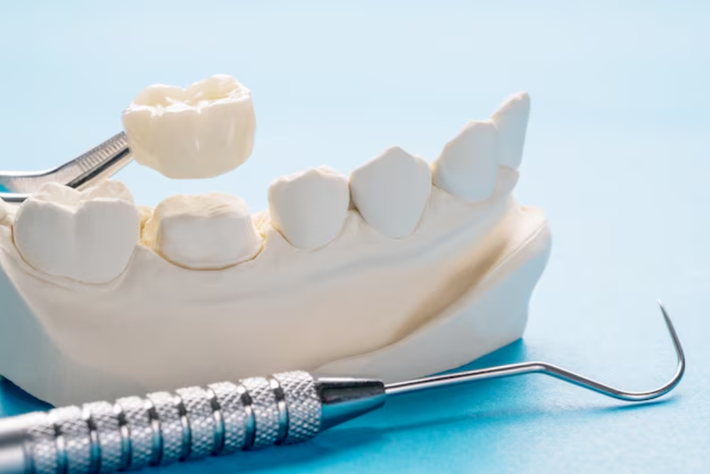 Do Teeth Go Bad Under Crowns?