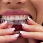 invisalign aligners improving smile appearance