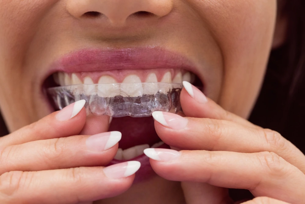 invisalign aligners improving smile appearance